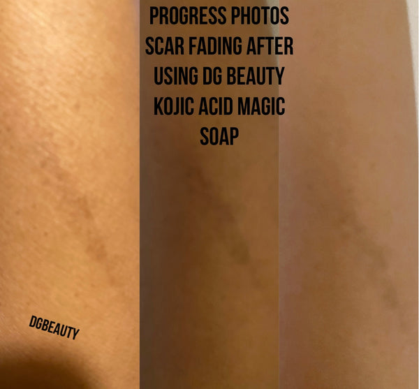 Best seller Kojic acid hyperpigmentation dark spot remover acne soap